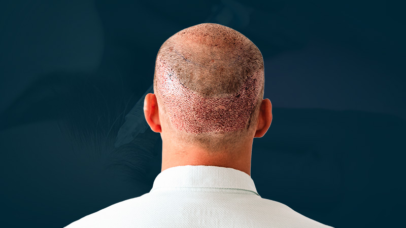 Hair transplant DHI in 2026